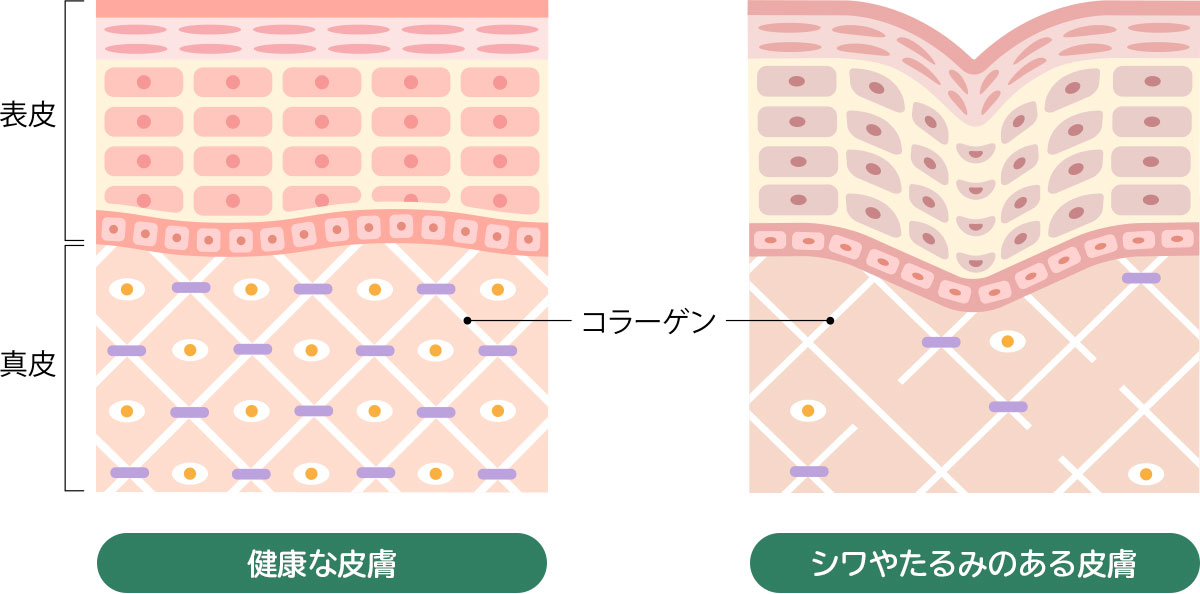 シワやたるみのある皮膚